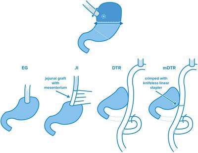 Indications and technical aspects of proximal gastrectomy